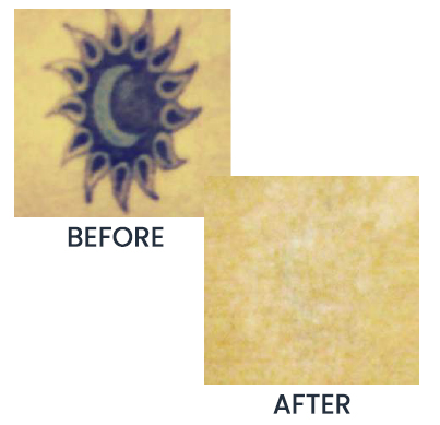 Tatoo Removal